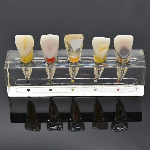 Vista 9 de Modelo patológico de restauración de pulpa dental de diente frontal, modelo endodóntico humano