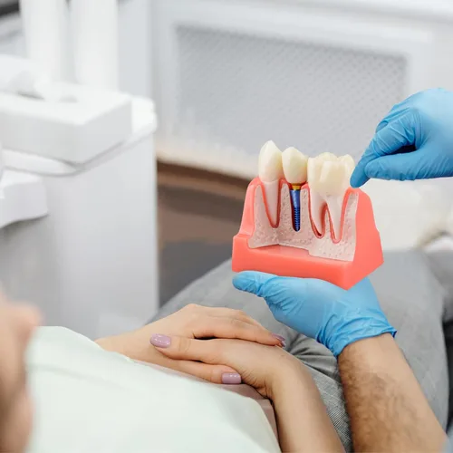Vista 7 de Ultrassist Modelo de implante dental para la educación del paciente, 4 veces implante dental, modelo de corona y puente para presentación-rosa