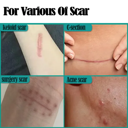 Vista 4 de Cinta de silicona para cicatrices de 1.6 x 120 pulgadas, 2 rollos de cinta de silicona para cicatrices quirúrgicas, parches de queloides, hojas