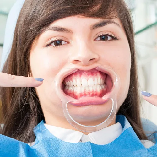 Vista 6 de 10 piezas de retractor de mejillas en forma de C, abridor de boca desechable para blanqueamiento dental, protector bucal o juego Speak Out