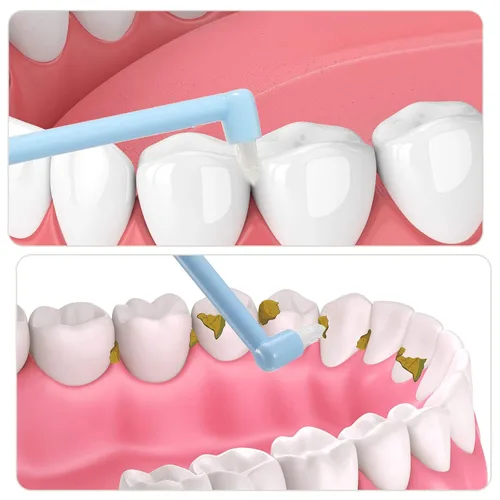 Vista 3 de Patelai 6 piezas de cepillo de dientes con mechón de extremo, cepillo de dientes interdental suave, removedor de manchas de dientes para implantes