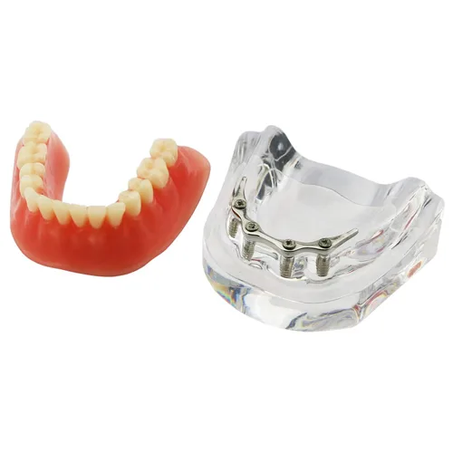 Vista 8 de Dental Dientes Modelo Oro Plata Demostración Color Practise Enseñanza Demo 4 Implante (GOLD BAR)