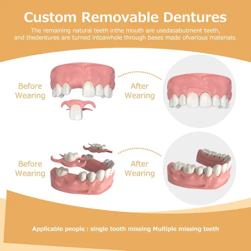 Vista 5 de Prótesis parciales – Dentaduras postizas para dientes perdidos y huecos – Dientes de repuesto ligeros e irrompibles para hombres y mujeres (1 diente)