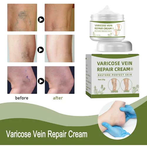 Vista 5 de Crema de venas varicosas, crema reparadora de arañas vasculares, tratamiento de venas varicosas para piernas (1.76 oz)