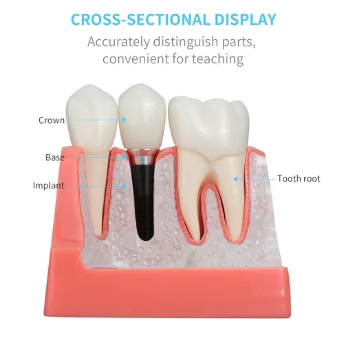 Vista 3 de ANNWAN Modelo de implante dental 4 veces análisis extraíble Puente de corona Demostración Modelo de dientes para educación de clase y estudio